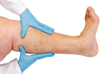 NanoVein used to treat, varicose veins, thrombosis, related diseases