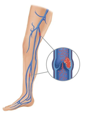 The because of the varicose veins