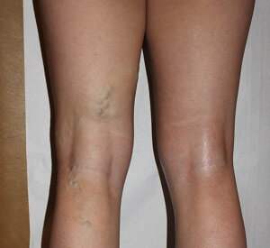 The legs before applying NanoVein