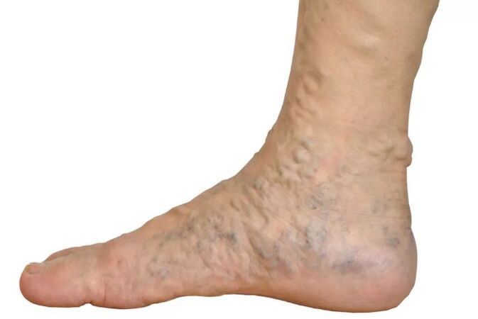 Veen's disease on the feet
