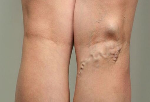 Venous disease