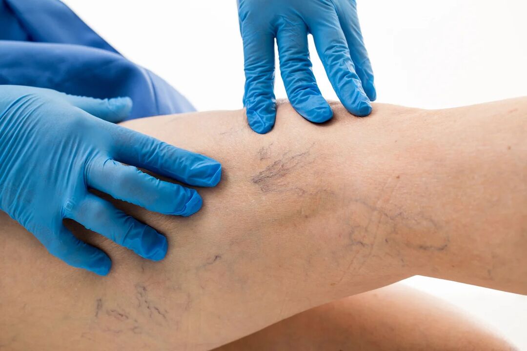 Net varicose veins