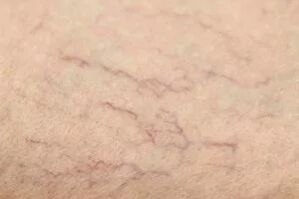 Vascular
