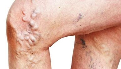 The main manifestations of venous veins on the legs