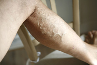 What is forbidden with varicose veins