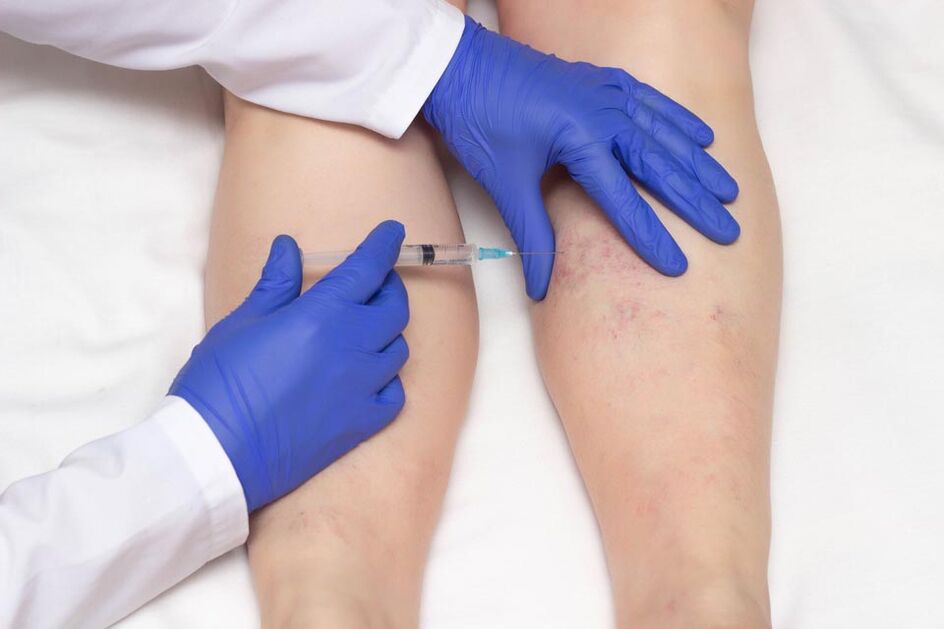 Sclerotherapy is a treatment for varicose veins