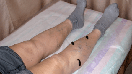 Treat varicose veins with leeches