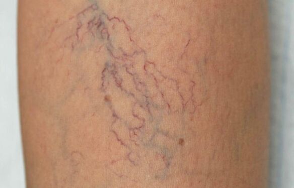 Varicose veins in the legs in women