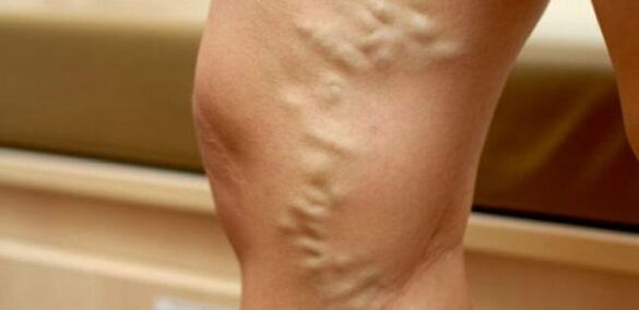 Varicose veins in women's legs