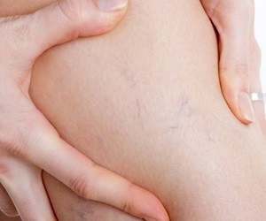 treatments for varicose veins