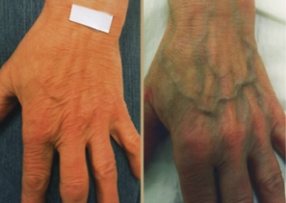 the cause of varicose veins on the hands