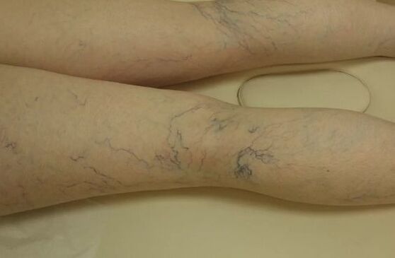 Star Charicose on the legs