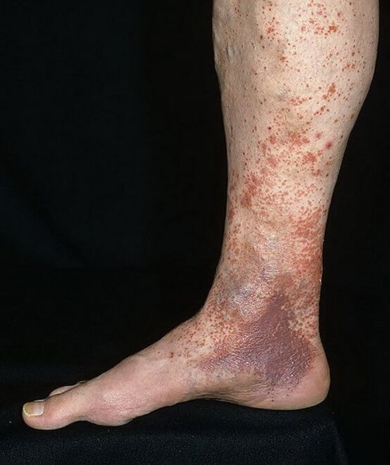 Vaginal dermatitis