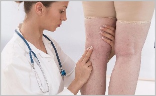 A woman consulted a doctor with obvious signs of varicose veins