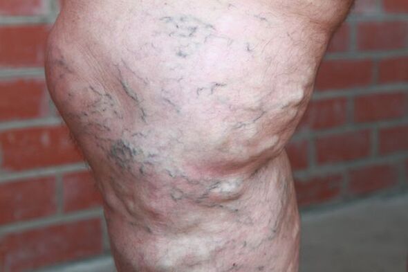 Varicose veins