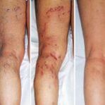 Varicose veins in the legs