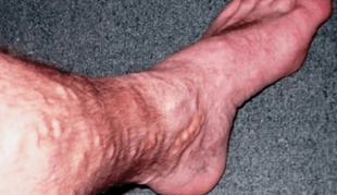 Causes varicose leg veins in men