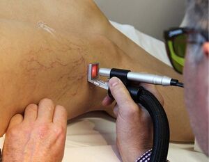 Contraindicated laser varicose therapy