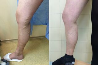 Laser treatment of varicose veins before and after the image