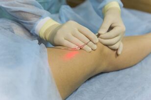 Treatment for varicose veins with laser is the essence of the procedure