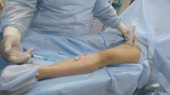 leg varicose vein surgery