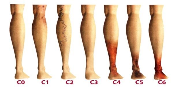 stages of development of varicose veins in the legs