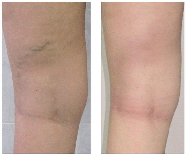 veins in the legs before and after varicose veins treatment