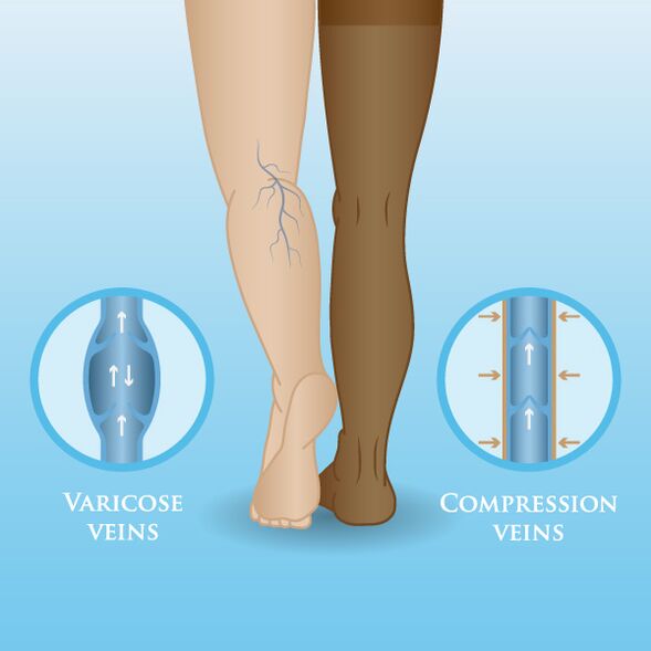 Effect of compression clothing on varicose veins in the legs