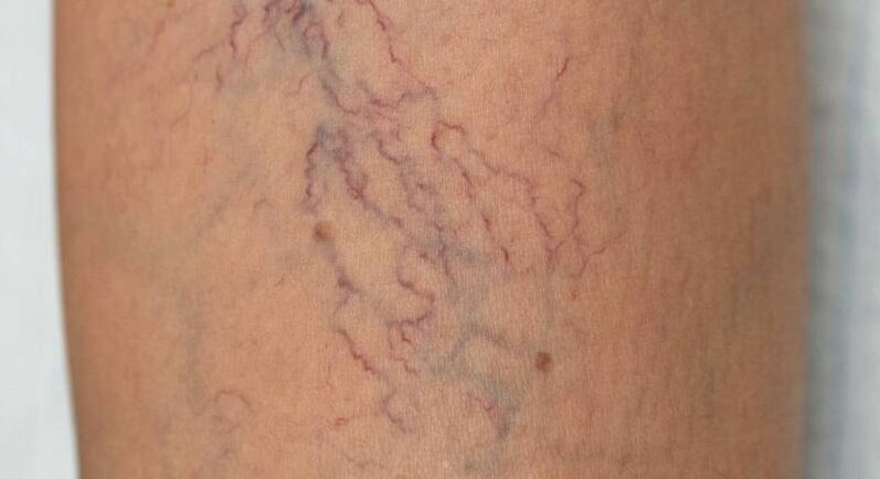 Venous network for varicose veins