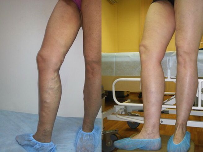 Legs before and after laser varicose veins treatment