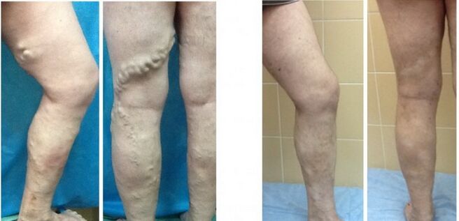 Radio frequency front and rear legs clear varicose veins