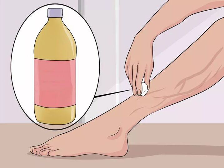 How to apply apple cider vinegar to the affected areas 