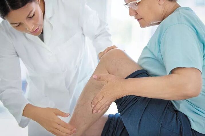 Varicose veins treatment by doctor