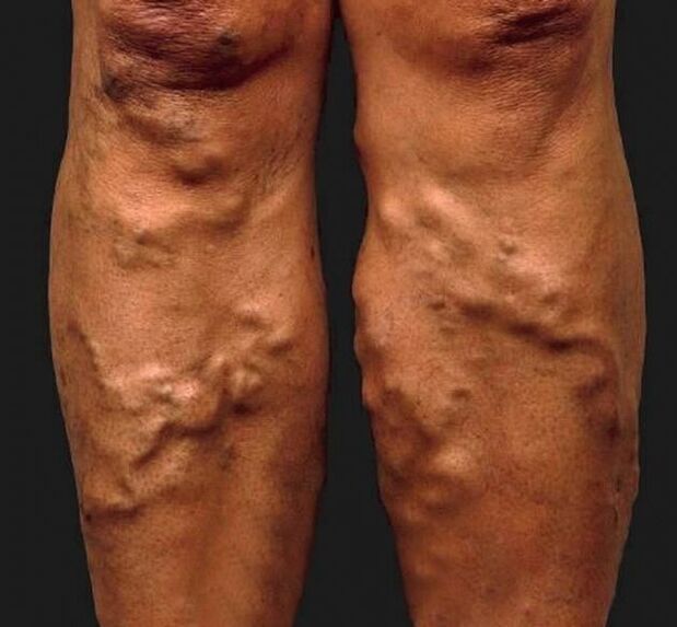 neglected leg varicose veins