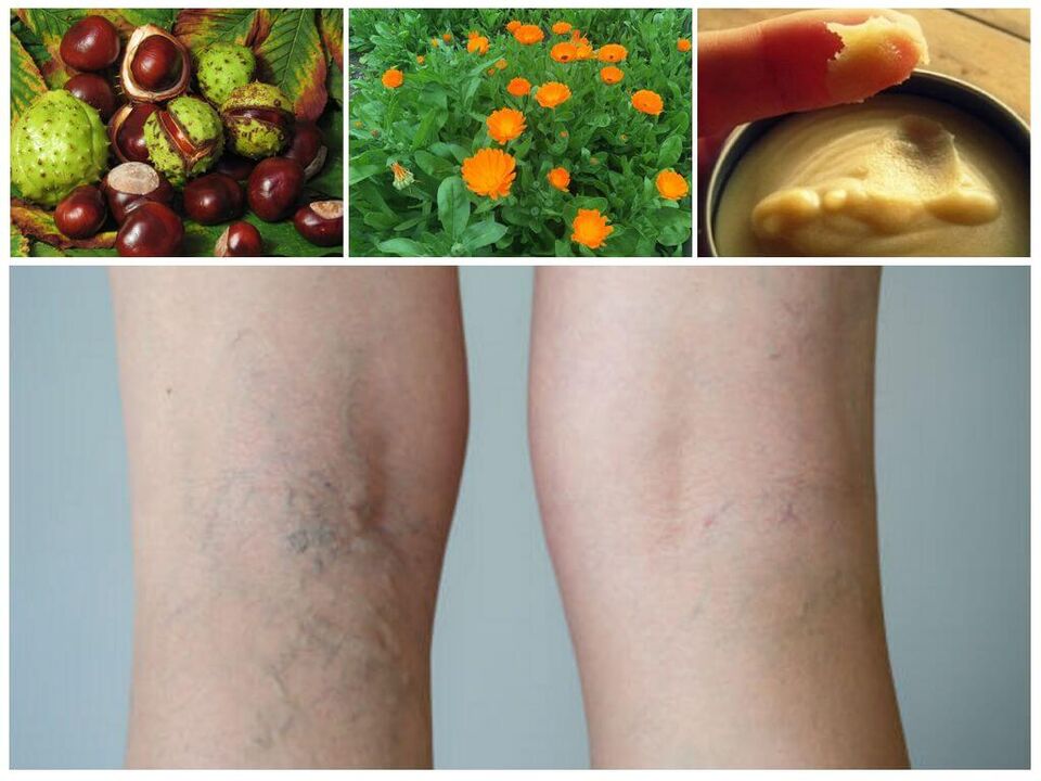 Varicose veins in the legs and folk remedies to prevent it