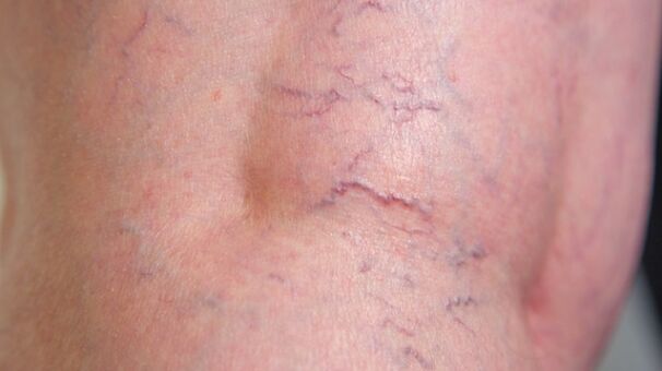 Signs of reticular varices of the lower extremities - dilation of small and reticular veins
