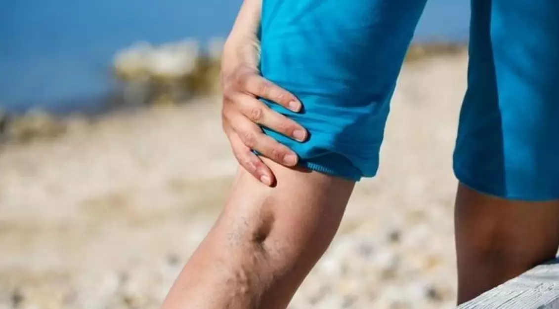 Blue veins in the legs are a sign of varicose veins. 