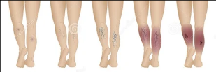 Varicose veins of the lower limbs stage